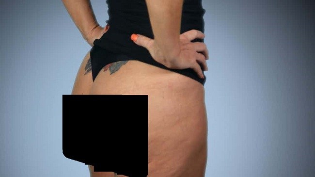 Botched butt implants